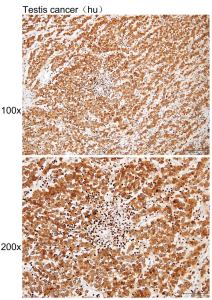 Immunohistochemistry of paraffin-embedded Human testis cancer with ALPPALPGALPI antibody diluted at 180