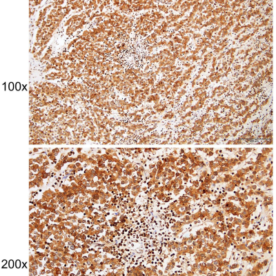 Immunohistochemistry of paraffin-embedded Human testis cancer with ALPPALPGALPI antibody diluted at 1 a 180