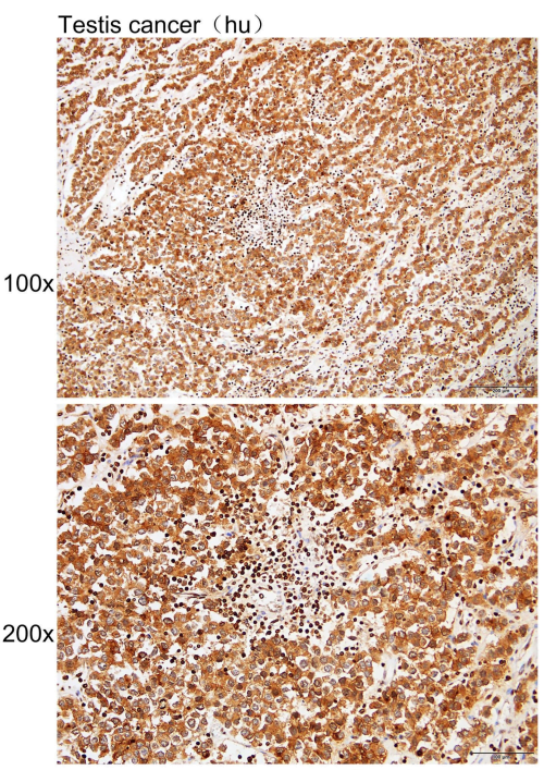 Immunohistochemistry of paraffin-embedded Human testis cancer with ALPPALPGALPI antibody diluted at 1 to 180