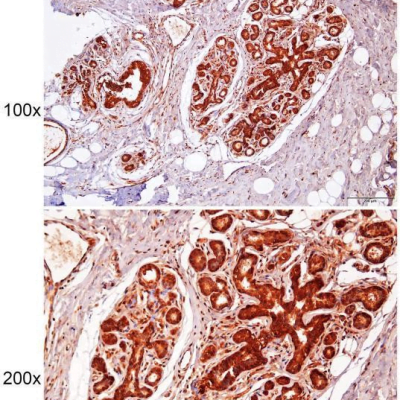 Immunohistochemistry of paraffin-embedded Human breast cancr with DPH7 antibody diluted at 1:200