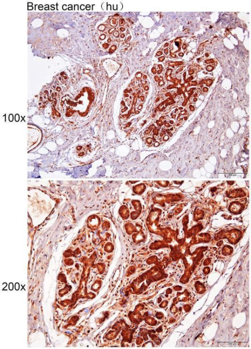 Immunohistochemistry of paraffin-embedded Human breast cancr with DPH7 antibody diluted at 1:200