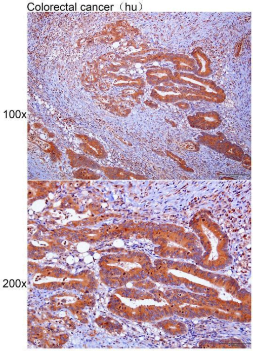 Immunohistochemistry of paraffin-embedded Human colorectal cancer with APOOL antibody diluted at 1:100